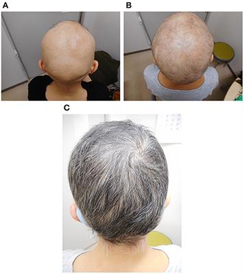 Case Report: A Case of Myeloproliferative Neoplasm Complicated by Alopecia Areata